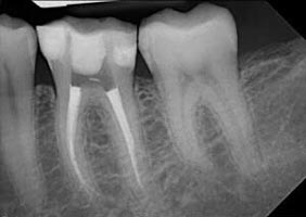 ฟันหลังรากฟันอาจจะโค้งและการรักษามักจะซับซ้อน
