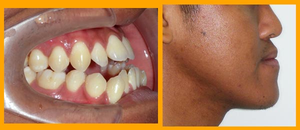 ฟันล่างค่อมบนจากความผิดปรกติของขากรรไกร-WeDent-Clinic