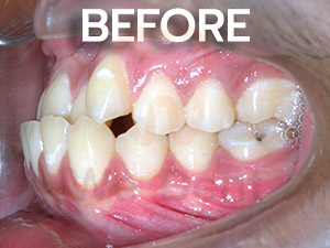 รูป-case-ตัวอย่างฟันล่างคร่อมฟันบนก่อนรักษาแบบไม่ผ่าตัด-WeDent-Clinic