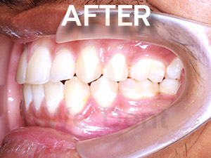 รูป-case-ตัวอย่างฟันล่างคร่อมฟันบนหลังรักษาแบบไม่ผ่าตัด-WeDent-Clinic
